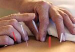 acupuntura-curitiba-1418067760