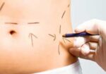 cirurgia-plastica-curitiba-1418049115