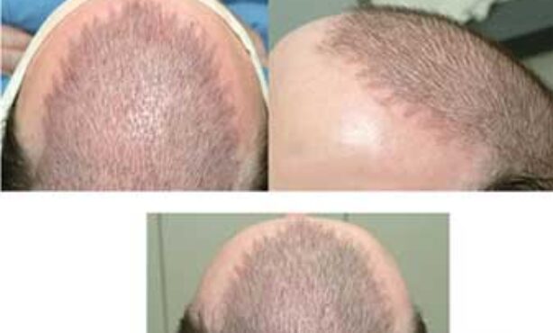 Interlace Recuperação Capilar - Foto 1