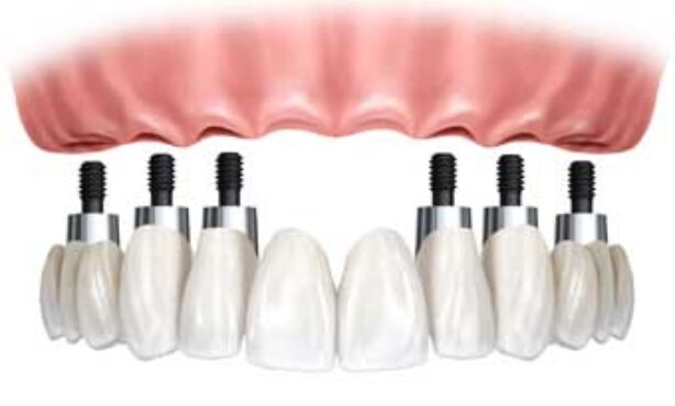 Laprodente Próteses Dentárias - Foto 1